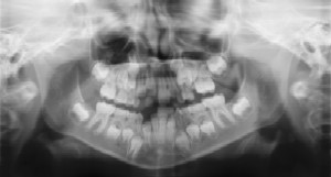 Dental Radiographs (X-Rays) - Pediatric Dentist in Paducah, KY