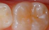 Sealant-Before - Pediatric Dentist in Paducah, KY