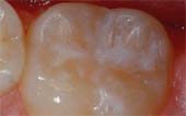 Sealant-After - Pediatric Dentist in Paducah, KY