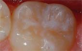 Sealant-After - Pediatric Dentist in Paducah, KY